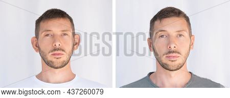 Otoplasty. Ear Surgery. Before And After The Operation. Plastic Surgery Concept