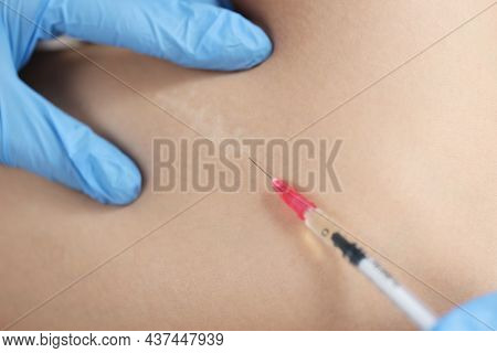 Doctor Injecting Medication In Area Of Postoperative Scar On Skin Closeup