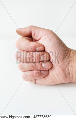 Treatment Of Skin Diseases. Psoriasis, Eczema, Dermatitis, Diathesis On Human Hands. Close-up