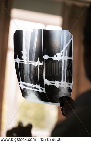 Close Up Of A X-ray In Doctor Hand Checking On Patient With Ilizarov Apparatus Fixation After Orthop