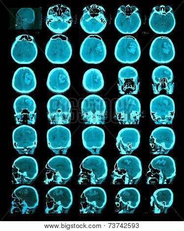 Ct Scan Of The Brain. Hemorrhagic Stroke.