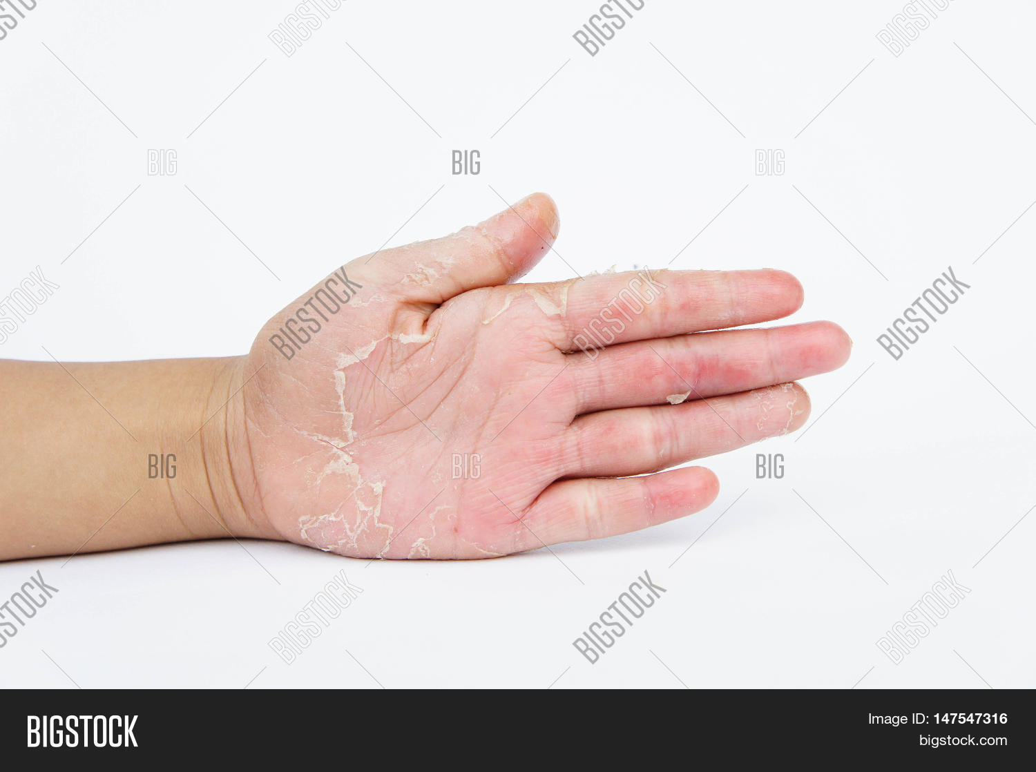 Dry Hands Peel Contact Image & Photo (Free Trial) Bigstock