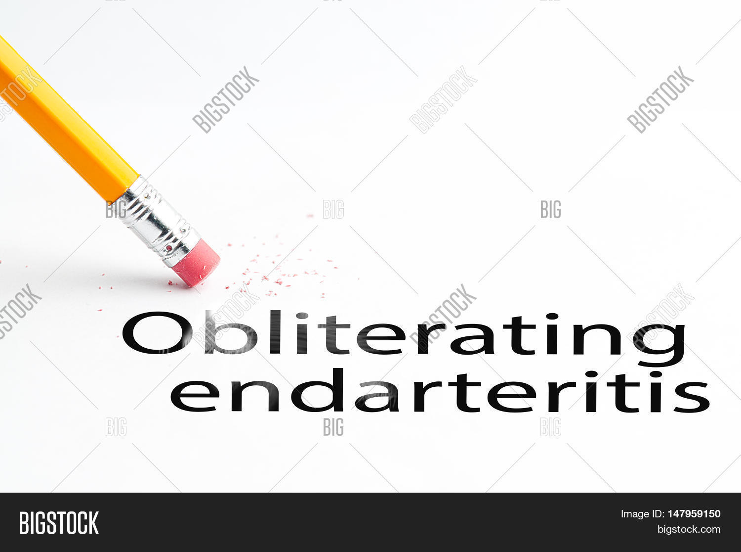 Obliterating endarteritis - symptoms and treatment Obliterating endarteritis - symptoms and treatment