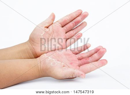 Dry hands peel Contact dermatitis fungal infections Skin infections from exposure