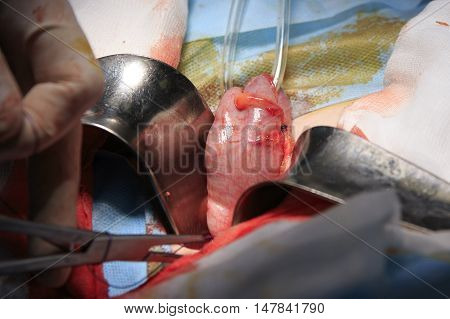 gut outside the body close-up during the colostomy surgery