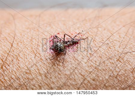 Close-up Of Smashed Mosquito (aedes Aegypti) Sucking Blood To Died On Human Skin., Mosquito Is Carri