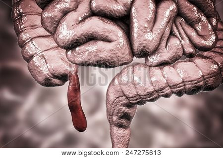 Acute Appendicitis, 3d Illustration Showing Inflammed Appendix On The Cecum