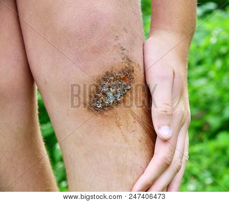 Legs Of A Teenager With A Purulent Abrasion On His Knee