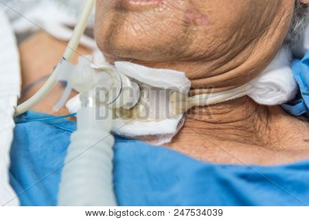 Patient Do Tracheostomy And Ventilator In Hospital