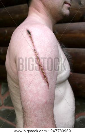 Shoulder With Big Scar