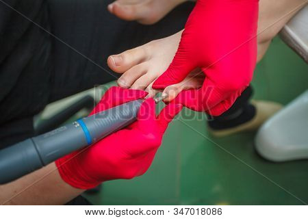 Podiatrist Treating Toenail Fungus. Podology Treatment. Close-up.