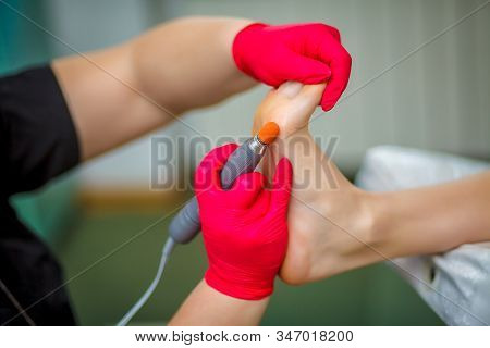 Podiatrist Treating Toenail Fungus. Podology Treatment. Close-up.