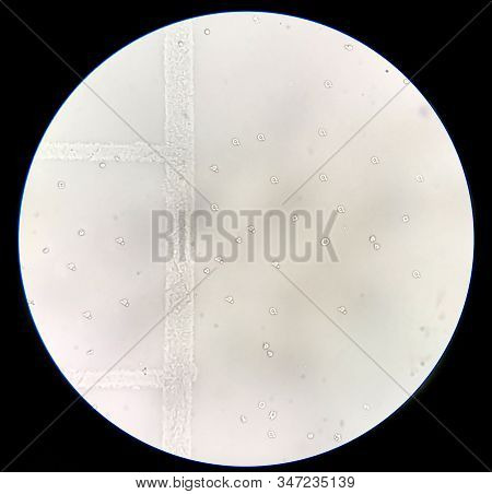 Moderate Dysmorphic Red Blood Cells In Urine Sediment.