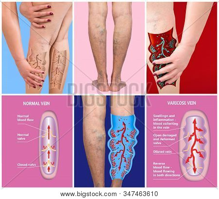 Varicose Veins On A Female Senior Legs. Concept Of Dry Skin, Old Senior People, Varicose And Deep Ve