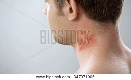 Red Spots On Male Patient Neck, Bites Of Insects, Allergy, Contact Dermatitis