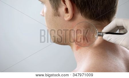 Therapist Examines Rash On Patient Neck With Magnifying Glass, Dermatology