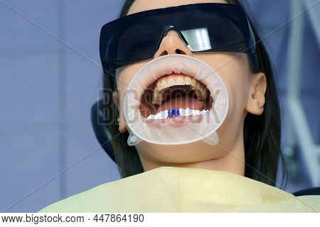 Blue Acid On Womans Teeth Before Installing Veneers And Ceramic Crowns. Dental Treatment, Preparatio