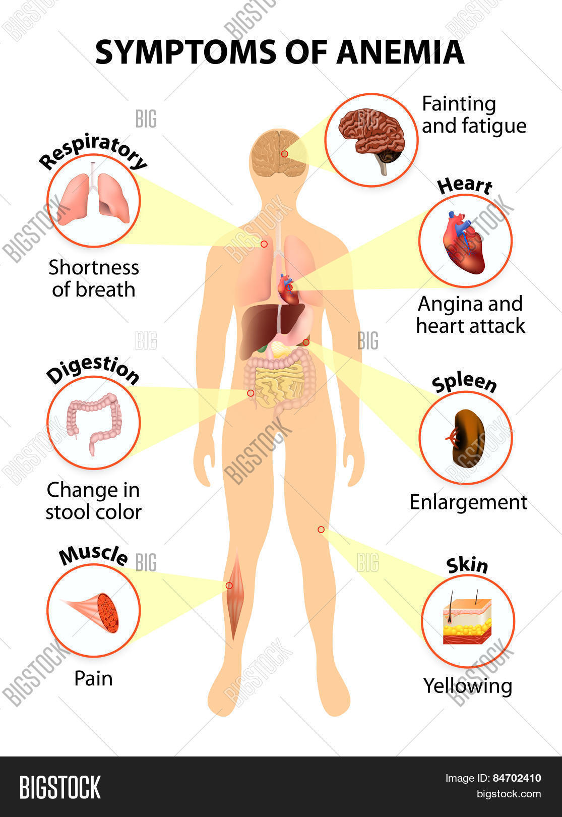 причины низкого гемоглобина. как понять что низкий гемоглобин. признаки низкого гемоглобина у девушек. симтомы анимия железодефицитная анемия. железо крови при железодефицитной анемии.