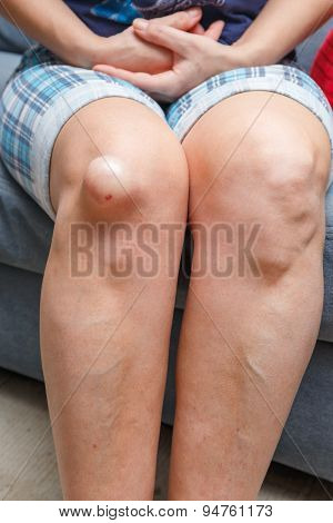 Female Injured Knee, Close Up