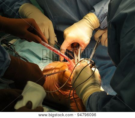 Prosthesis Of The Knee Hospital Operation