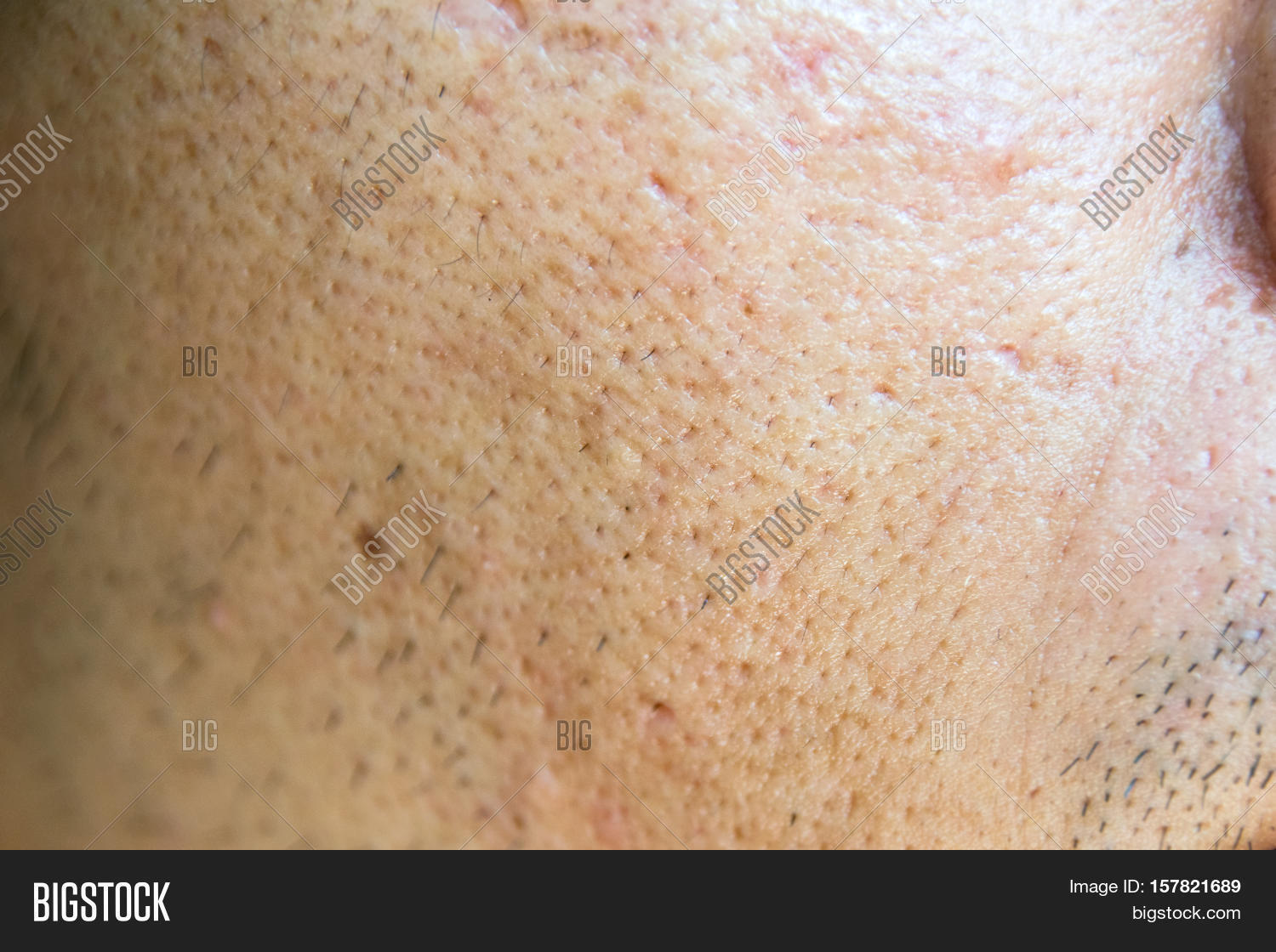 Close Acne Acne Holes Image & Photo (Free Trial) Bigstock