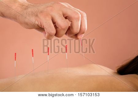 Close-up Of A Woman Getting Acupuncture Treatment In Beauty Spa