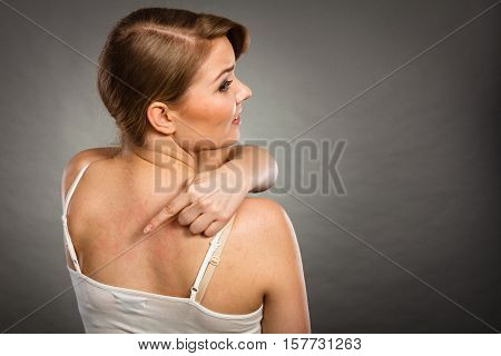 Health problem skin diseases. Young woman showing her itchy back with allergy rash urticaria symptoms