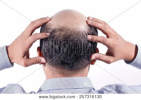 Bald Businessman With His Head On Scalp View From Behind With White Background