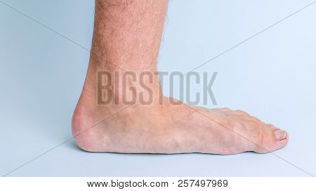 The Left Leg Of A Man With Signs Of Joint Disease And Flat Feet.