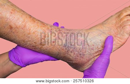 Close-up Of Skin With Varicose Veins On Senior Male Leg. Concept Of Dry Skin, Old Senior People, Var