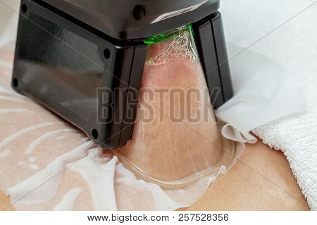 Woman Getting Cryolipolysis Fat Treatment Procedure In Professional Cosmetic Cabinet Or Spa Center