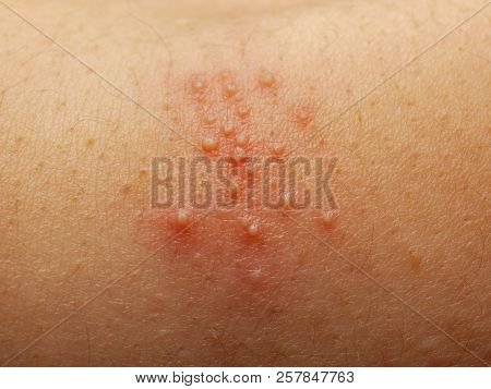 Close Up Of Girl Has Rash And Other Nonspecific Skin Eruption On Her Shoulders. May Be Caused By Dir
