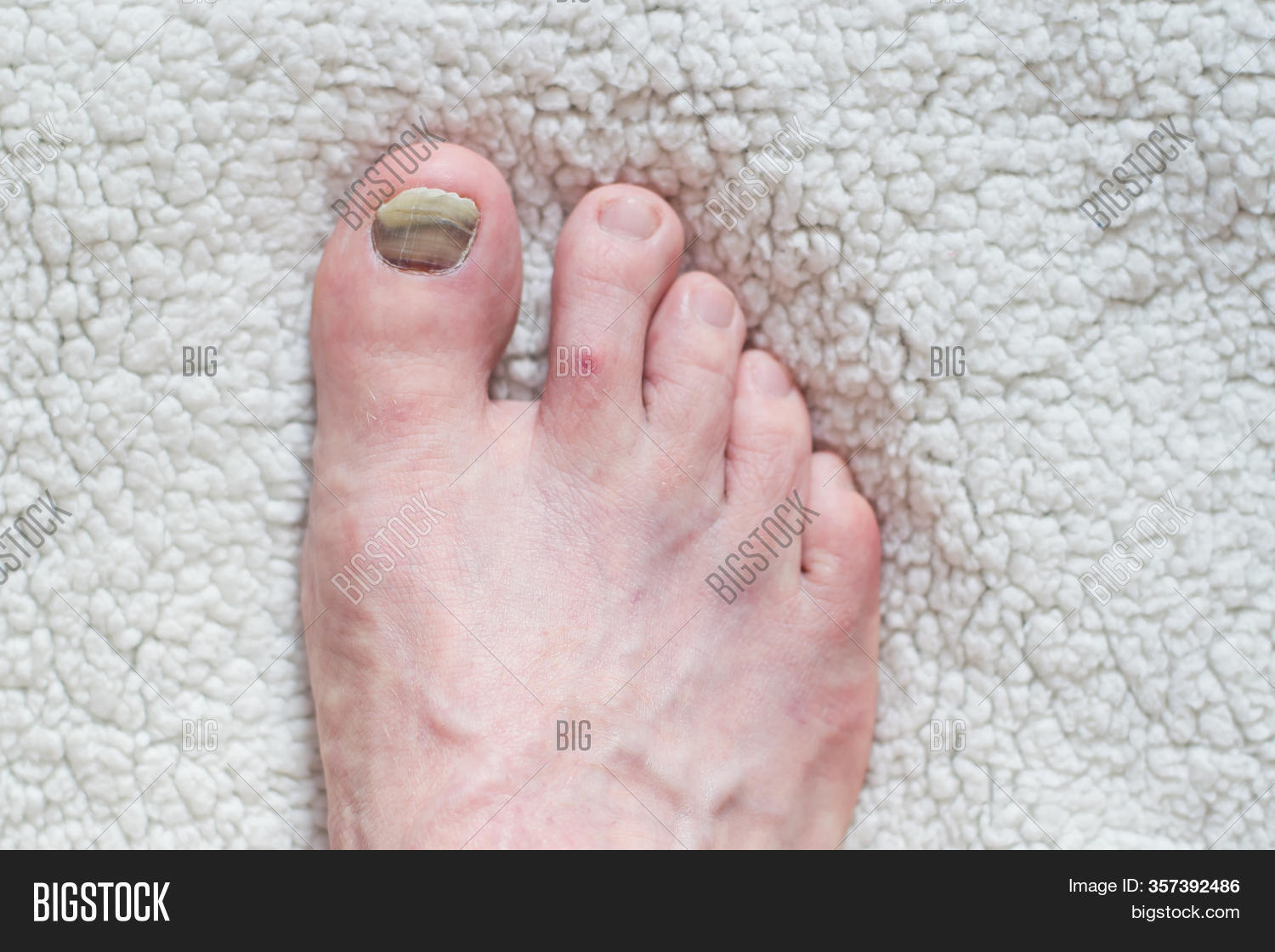 Nail Injury Treatment Image & Photo (Free Trial) Bigstock