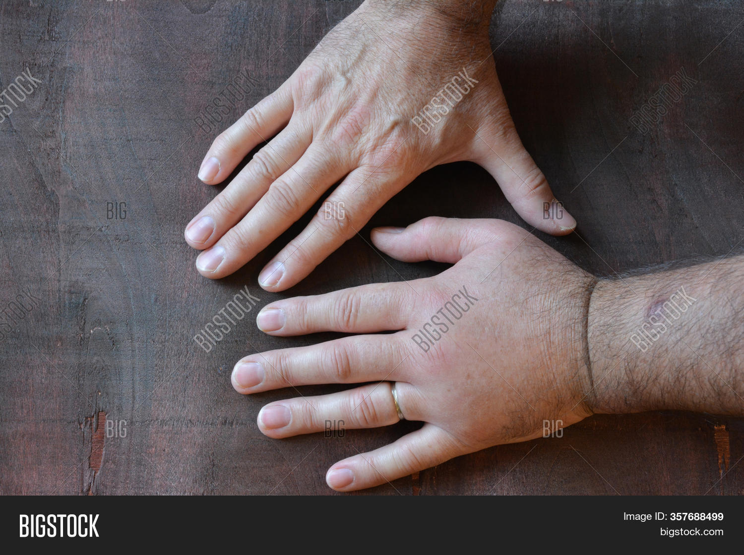 Swollen Fist Sting Image & Photo (Free Trial) Bigstock