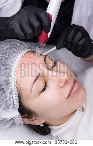 Cosmetologist Making Mesotherapy Injection. Microneedle Mesotherapy. Treatment Woman At Beautician. 