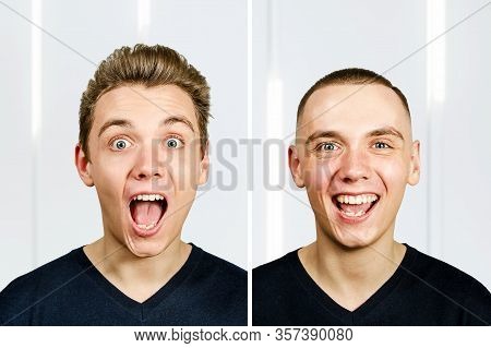 Man Before Arter Haircut With Hair Loss: Bald And Pompadour, Transplant And Transformation