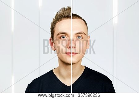 Portrait Of Young Man Before Arter Haircut With Hair Loss: Bald And Pompadour, Transplant And Transf