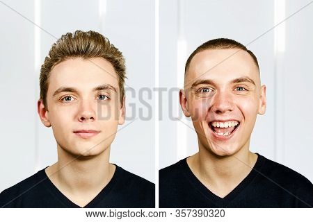 Portrait Of Young Man Before Arter Haircut With Hair Loss: Bald And Pompadour, Transplant And Transf