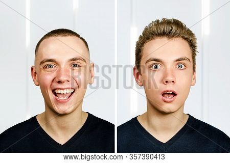 Guy Before Arter Haircut With Hair Loss: Bald And Pompadour, Transplant And Transformation