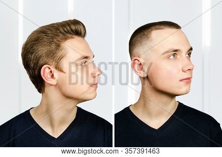 Man Before Arter Haircut With Hair Loss: Bald And Pompadour, Transplant And Transformation In Profil