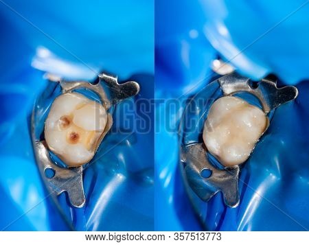 Treatment Tooth Decay With Subsequent Filling With Photopolymer Material. Close-up, Macro