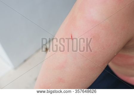 Dermatitis Herpetiformis Skin Rash In A Woman With Nonceliac Gluten Sensitivity. Serum Antibodies Po