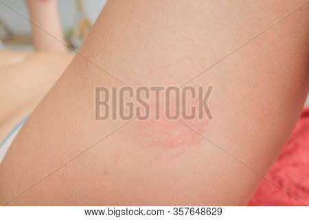 Dermatitis Herpetiformis Skin Rash In A Woman With Nonceliac Gluten Sensitivity. Serum Antibodies Po