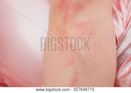 Dermatitis Herpetiformis Skin Rash In A Woman With Nonceliac Gluten Sensitivity. Serum Antibodies Po