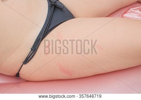 Dermatitis Herpetiformis Skin Rash In A Woman With Nonceliac Gluten Sensitivity. Serum Antibodies Po