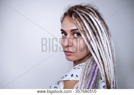 Girl With Bad Skin Acne And Black Red Festering Pimples  On The Face And Body