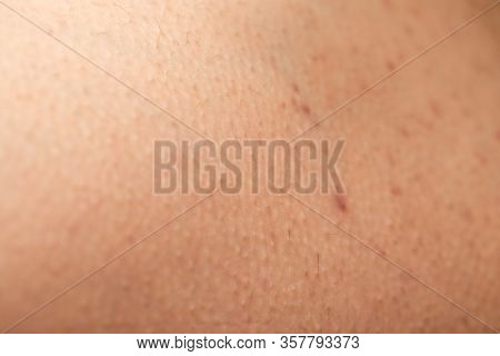 Close Up Picture Of Folliculitis On Human Skin - Hormonal Imbalance
