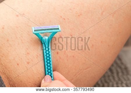 Close Up Picture Of Woman Holding Razor, Shaving Her Hairy Leg With Folliculitis