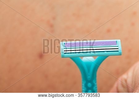 Close Up Picture Of Woman Holding Razor, Shaving Her Hairy Leg With Folliculitis