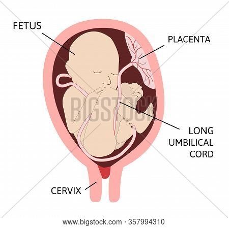 Long Umbilical Cord. Measures Less Than Normal Length.